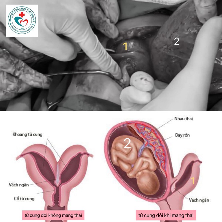 BVĐK Chương Mỹ phẫu thuật thành công ca chuyển dạ đặc biệt- Ảnh 1.