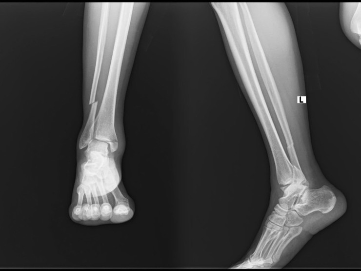 Áp dụng kỹ thuật cao trong phẫu thuật chấn thương chỉnh hình mang lại lợi ích cho người bệnh- Ảnh 1.