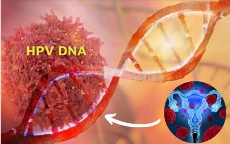 Bệnh viện Ung Bướu Hà Nội khuyến cáo phụ nữ chủ động sàng lọc HPV để phòng ngừa ung thư cổ tử cung- Ảnh 1.