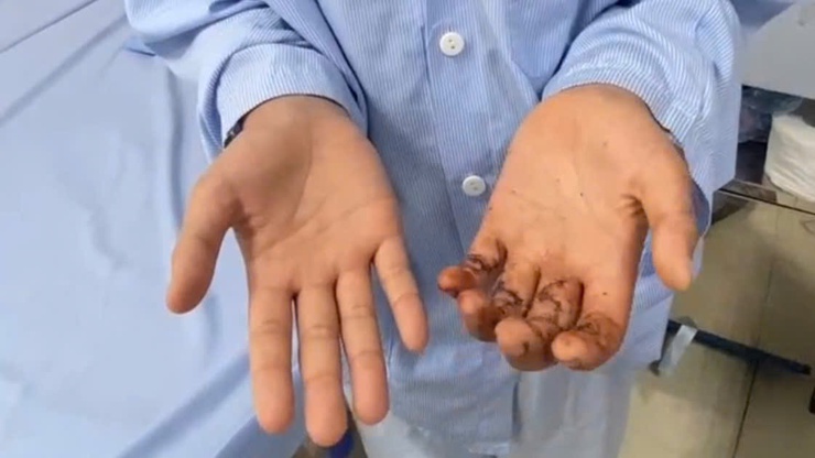 Xử trí sớm chấn thương bàn tay ở trẻ để bảo toàn chức năng vận động- Ảnh 1.