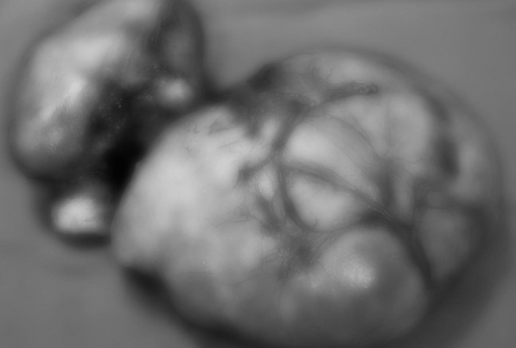 BVĐK Đông Anh phẫu thuật thành công cho bệnh nhân u xơ tử cung thoái hoá nhầy khổng lồ- Ảnh 1.