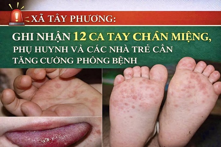 Ghi nhận 12 ca tay chân miệng tại xã Tây Phương, cảnh báo nguy cơ biến chứng do virus EV71- Ảnh 1.