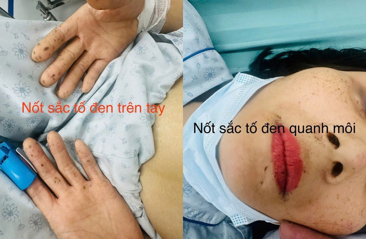 Từ ca tắc ruột non do polyp: Bệnh viện Đa khoa Xanh Pôn khuyến cáo phát hiện sớm bệnh di truyền để phòng ngừa ung thư- Ảnh 1.