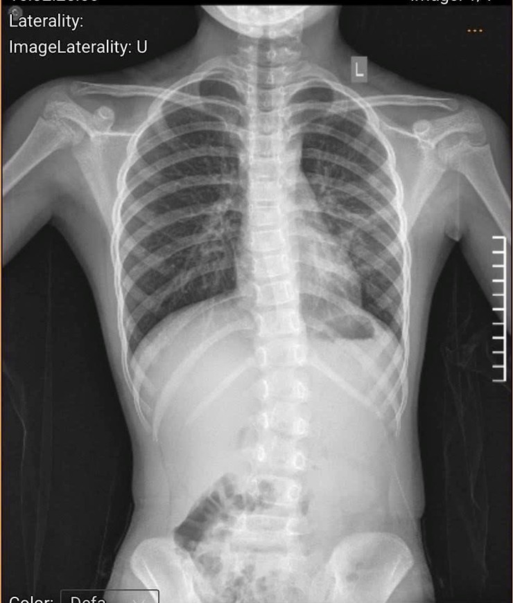 Bệnh viện đa khoa Sơn Tây khuyến cáo cần sớm phát hiện cong vẹo cột sống ở trẻ nhỏ- Ảnh 1.