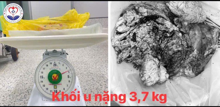 Chủ quan bỏ tái khám suốt 1 năm, người phụ nữ mang khối u xơ tử cung "khổng lồ"- Ảnh 1.