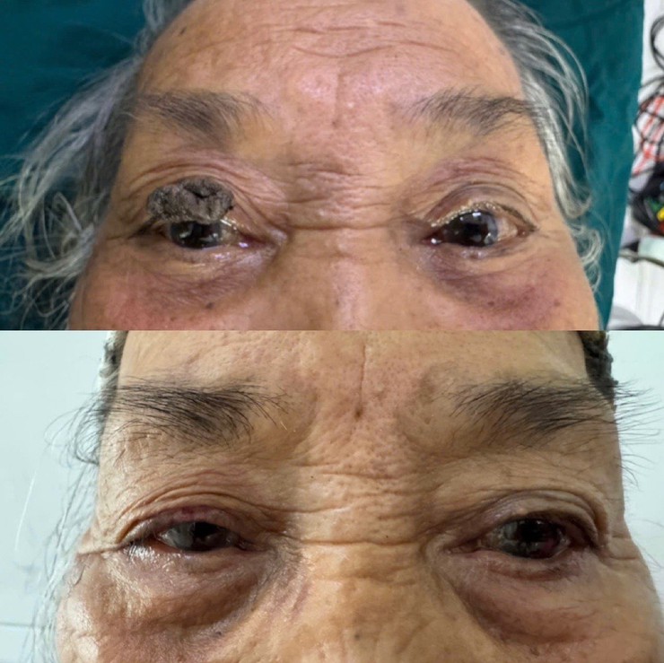 Cảnh báo không nên chủ quan với u nhú biểu mô vảy vùng mắt- Ảnh 1.