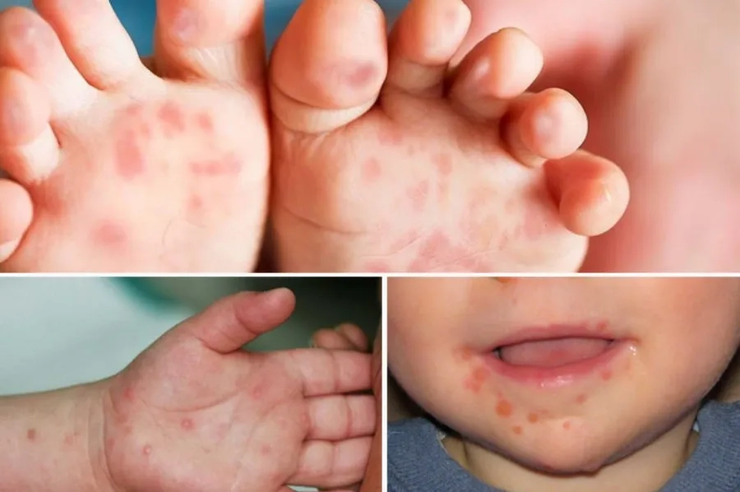 Bài tuyên truyền phòng chống bệnh Tay chân miệng- Ảnh 1.