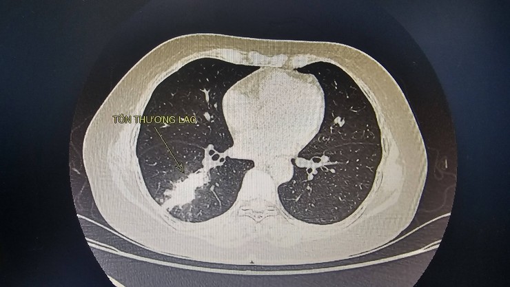 Khi ho ra máu nhiều là dấu hiệu nguy hiểm người bệnh không nên chủ quan- Ảnh 1.