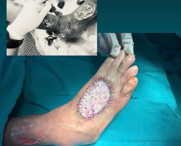 Bệnh viện đa khoa Đức Giang: Lần đầu triển khai kỹ thuật ghép giác mạc xuyên, tiến tới làm chủ ghép đa tạng- Ảnh 3.