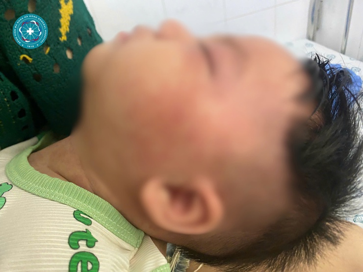 Nhận biết sởi ở trẻ em từ sớm: Những điều cha mẹ nhất định phải biết- Ảnh 1.