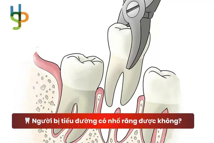 Có nên trì hoãn nhổ răng ở người mắc bệnh tiểu đường?- Ảnh 1.