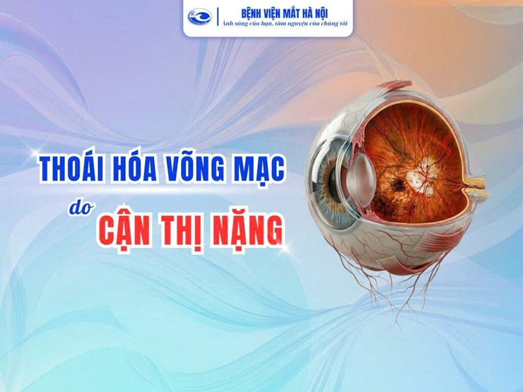 Thoái hóa võng mạc do cận thị nặng, tiềm ẩn nguy cơ gây mất thị lực- Ảnh 1.