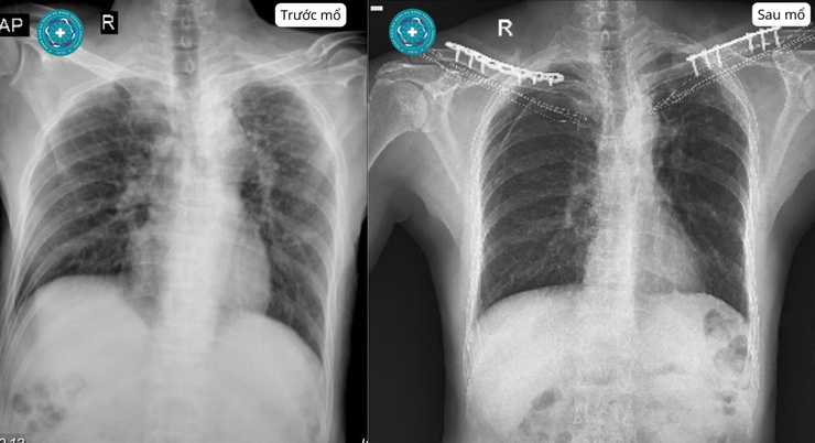 Nam bệnh nhân gãy cùng lúc hai xương đòn sau tai nạn giao thông- Ảnh 1.