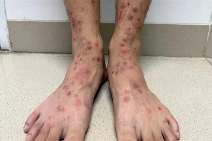 Sẩn ngứa do bọ chét gia tăng, nhiều ca có nuôi chó mèo- Ảnh 1.