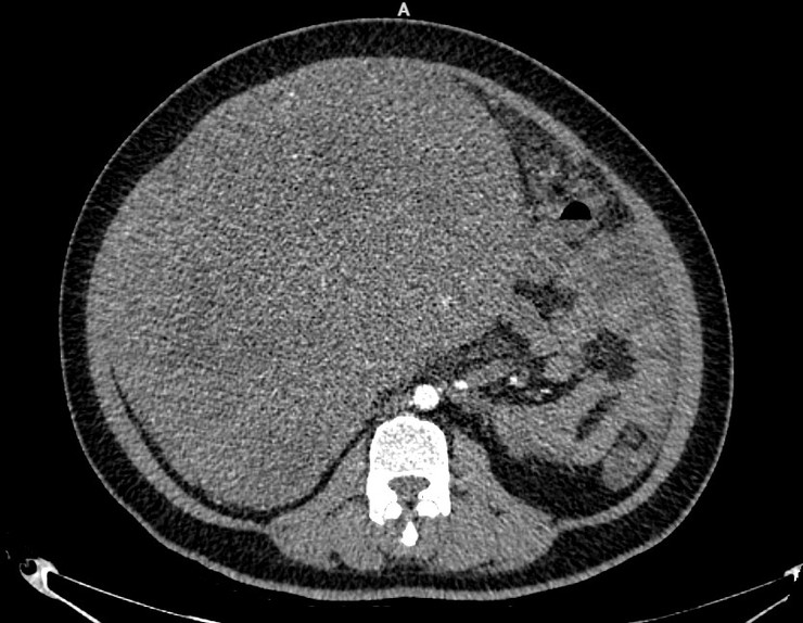 Chủ quan, e ngại không muốn đi khám người phụ nữ mang khối u sarcoma tử cung nặng gần 9kg- Ảnh 1.