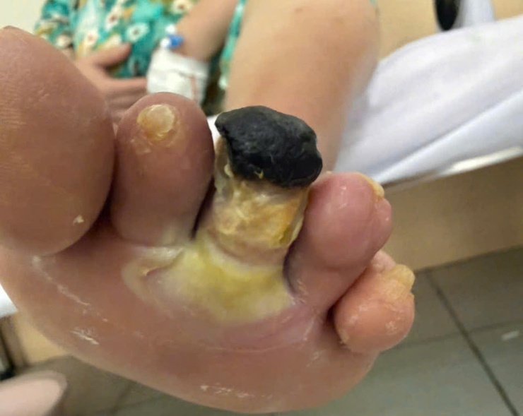 Bệnh viện đa khoa Đức Giang: Can thiệp thành công mạch máu nhỏ chi dưới giữ chi cho người bệnh đái tháo đường- Ảnh 1.