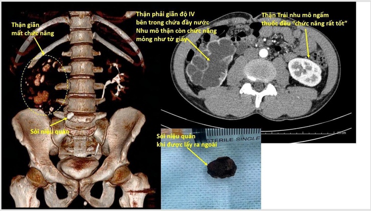 Bệnh viện Thận Hà Nội khuyến cáo không chủ quan với sỏi thận tiết niệu- Ảnh 1.