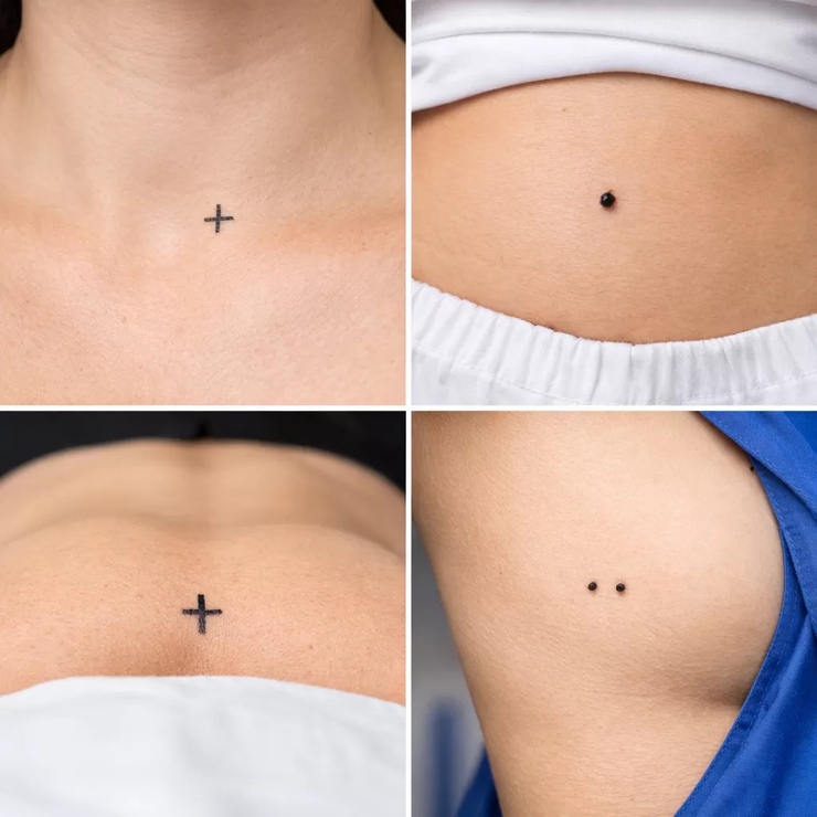 Xạ trị không xăm hình định vị: Bước tiến mới tại Bệnh viện Ung Bướu Hà Nội- Ảnh 1.