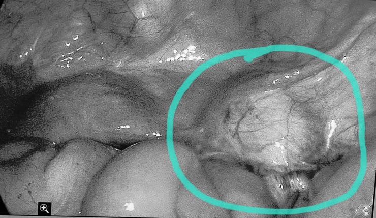Bệnh viện đa khoa Chương Mỹ xử trí thành công khối u dây chằng rộng ở người bệnh 61 tuổi- Ảnh 1.