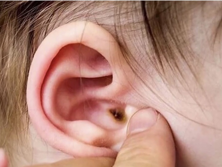 Đừng xem nhẹ viêm tai giữa cấp tính ở trẻ em- Ảnh 1.