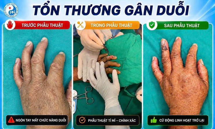 Bệnh viện đa khoa Hòe Nhai: Phẫu thuật phục hồi chức năng duỗi ngón tay thành công cho người bệnh tổn thương gân duỗi- Ảnh 1.