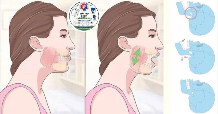 Đừng chủ quan với cơn đau hàm mặt kéo dài- Ảnh 1.