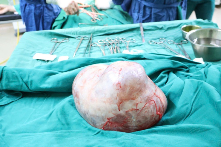 Bệnh viện đa khoa Ba Vì: Phẫu thuật thành công khối u nang buồng trứng nặng 4kg ở người bệnh 59 tuổi- Ảnh 2.