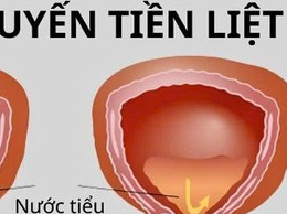 Bệnh viện đa khoa Mỹ Đức phẫu thuật nội soi tuyến tiền liệt bằng dao điện lưỡng cực