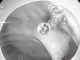 BVĐK Sóc Sơn cấp cứu thành công ca bệnh sốc giảm thể tích do xuất huyết tiêu hóa