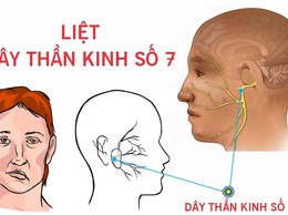 BVĐK Hòe Nhai: Cảnh báo liệt dây thần kinh số VII
