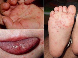Chủ động phòng chống bệnh tay chân miệng