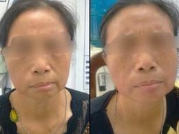 Hiệu quả điều trị liệt dây thần kinh số VII ngoại biên sau 14 ngày tại Bệnh viện đa khoa Vân Đình