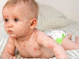 BÀI TUYÊN TRUYỀN PHÒNG BỆNH SỞI