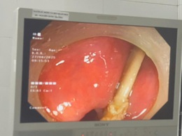 BVĐK Phúc Thọ thực hiện thành công ca gắp dị vật hóc xương gà