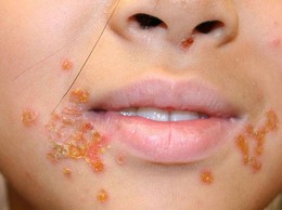 Không chủ quan với bệnh chốc