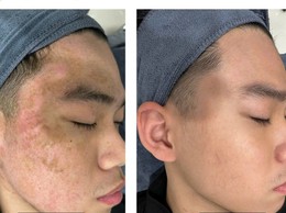Điều trị mụn ở tuổi dậy thì đừng để quá muộn
