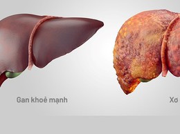 BVĐK Đống Đa cứu sống bệnh nhân mắc xơ gan mất bù nguy kịch