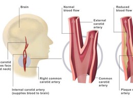 Cảnh báo hẹp động mạch cảnh - sát thủ thầm lặng gây nhồi máu não