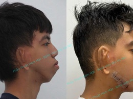 Cơ hội phẫu thuật miễn phí cho trẻ khe hở môi – vòm miệng dưới 16 tuổi tại Bệnh viện Nhi Hà Nội
