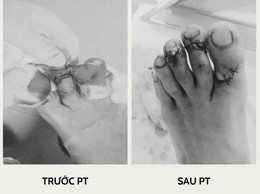 Phẫu thuật cấp cứu ca chấn thương do tai nạn lao động