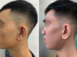 Đơn nguyên phẫu thuật Tạo hình & Hàm mặt tại Bệnh viện Nhi Hà Nội tạo nhiều dấu ấn trong các ca phẫu thuật tạo hình