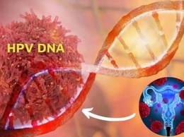 Bệnh viện Ung Bướu Hà Nội khuyến cáo phụ nữ chủ động sàng lọc HPV để phòng ngừa ung thư cổ tử cung