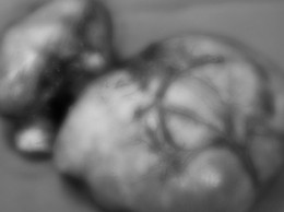 BVĐK Đông Anh phẫu thuật thành công cho bệnh nhân u xơ tử cung thoái hoá nhầy khổng lồ