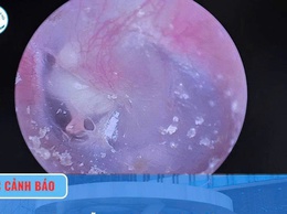 Cholesteatoma tai giữa ở trẻ em: Phát hiện sớm, điều trị kịp thời để tránh biến chứng