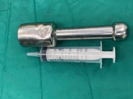 BVĐK Hà Đông lấy thành công dị vật kim loại lớn qua đường hậu môn cho thiếu niên 15 tuổi