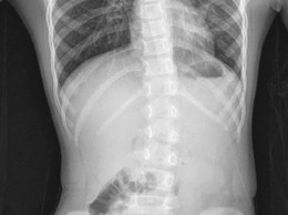 Bệnh viện đa khoa Sơn Tây khuyến cáo cần sớm phát hiện cong vẹo cột sống ở trẻ nhỏ