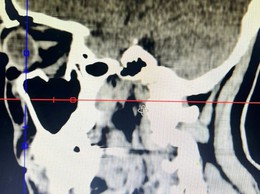 Cấp cứu kịp thời ca chấn thương hàm mặt phức tạp, phục hồi thị lực cho người bệnh