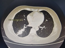 Khi ho ra máu nhiều là dấu hiệu nguy hiểm người bệnh không nên chủ quan