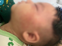 Nhận biết sởi ở trẻ em từ sớm: Những điều cha mẹ nhất định phải biết