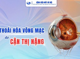Thoái hóa võng mạc do cận thị nặng, tiềm ẩn nguy cơ gây mất thị lực